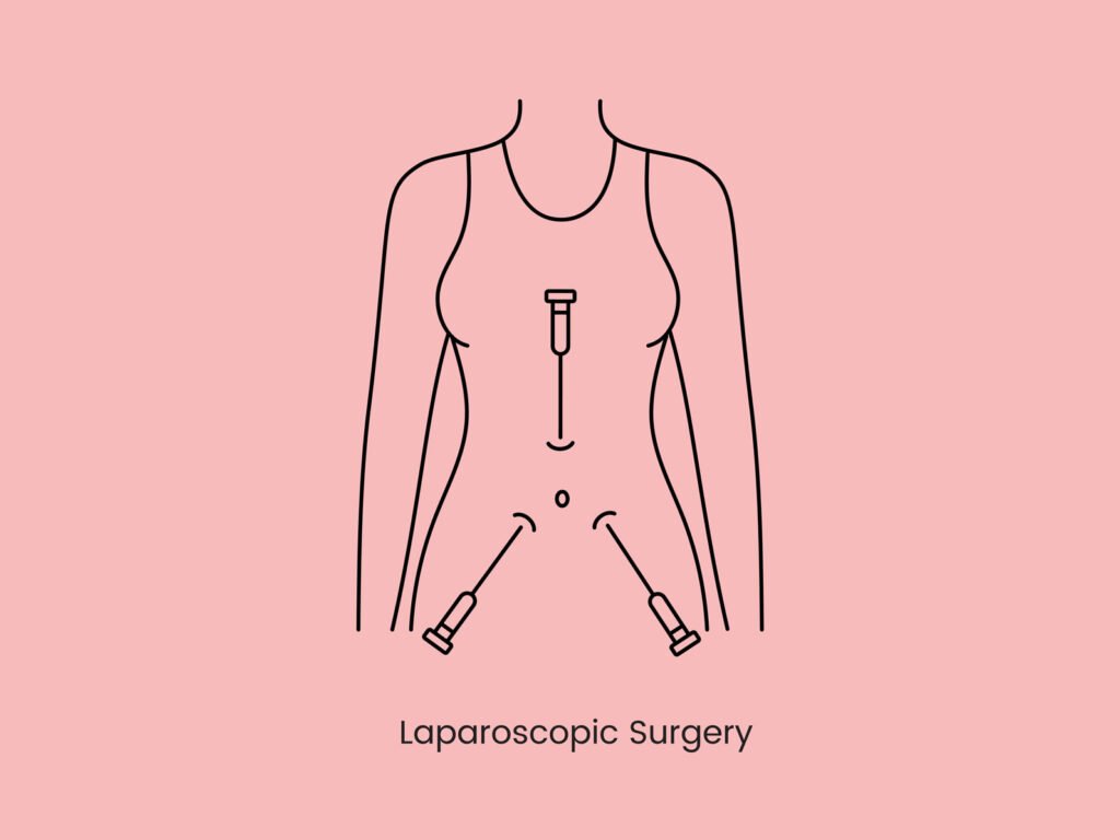 Laparoscopic-Myomectomy