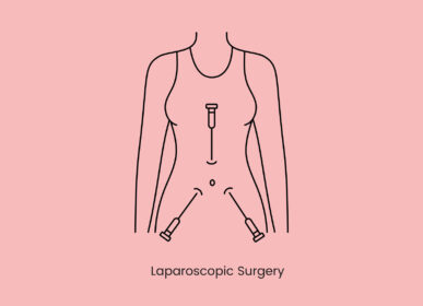 Laparoscopic-Myomectomy
