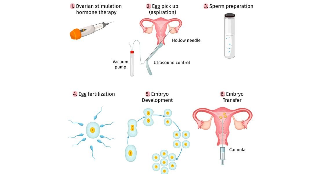 Understanding the Stages of IVF Journey in Ahmedabad