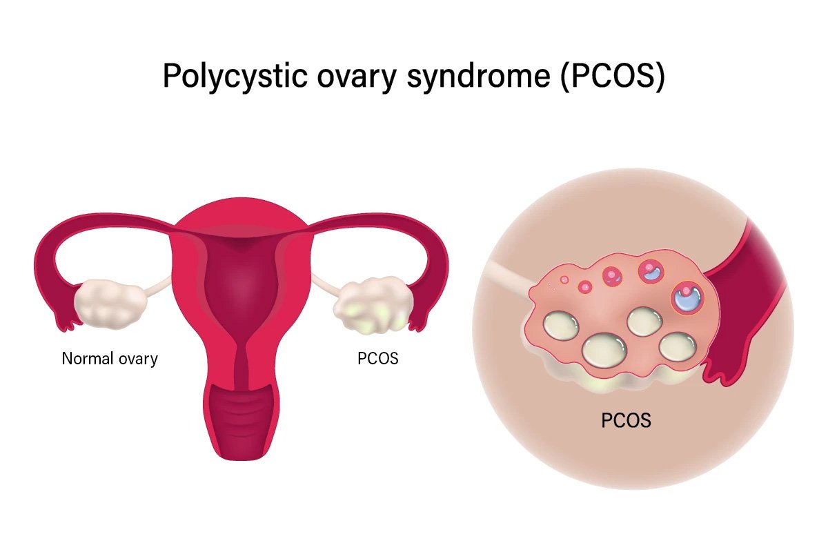 Best gynaecologist in Ahmedabad explaining PCOS treatment options at Lifeline Women Hospital